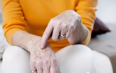 皮膚長老年斑怎么去掉，學(xué)會4招“吃”掉老年斑