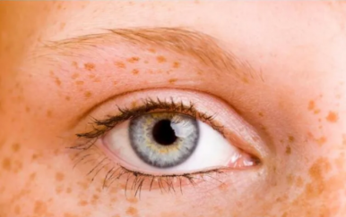 女人黃褐斑是怎么形成的？主要與這幾大因素有關