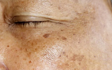 可怕的是老年斑，90后也不放過