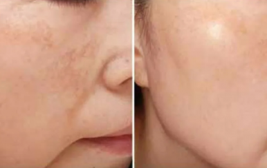 都說(shuō)祛斑難，對(duì)不起，那是他因?yàn)槟銢]選對(duì)方法！